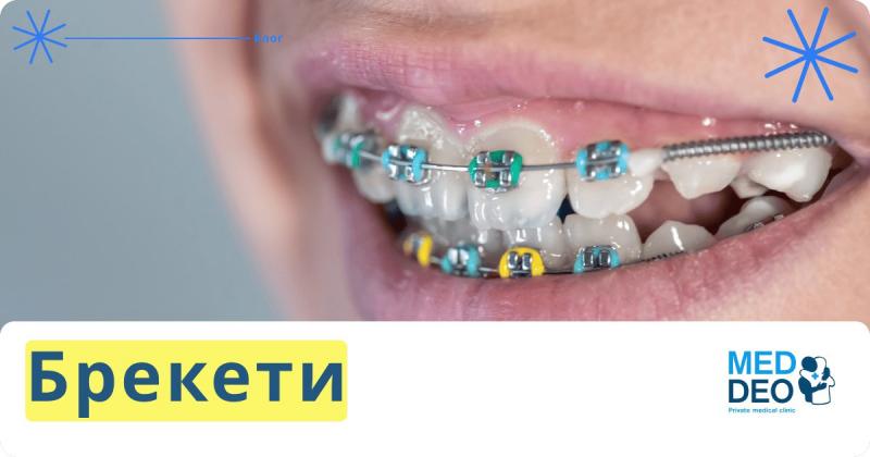 Брекети у 2025 році: яка реальна ціна ідеальної усмішки?